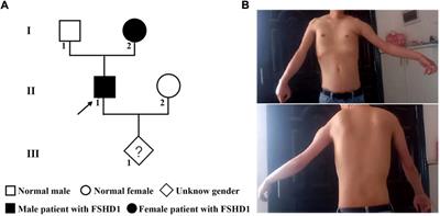 A feasibility study of noninvasive prenatal diagnosis in facioscapulohumeral muscular dystrophy type 1 in a Chinese family